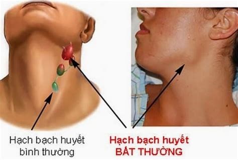 Các hạch bạch huyết của cơ thể người